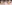 裏ハムラ法（経結膜的眼窩脂肪移動術） — SM美容外科クリニック