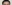 額リフト（前額リフト） — バタン美容外科クリニック