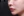 ศัลยกรรมยกริมฝีปากบน (Lip Lift) — ก่อนทำ (1วัน) · คลินิกเวอรีกูด
