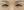 lower blepharoplasty (under-eye bag removal with fat repositioning) — after (7days) · Seoul During Clinic