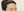 Forehead reduction (hairline lowering surgery) — after (10days) · The Fix Plastic Surgery Clinic