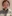 頬骨縮小術（全体／頬骨体部＋頬骨弓の骨切り） — オペラ美容外科クリニック