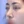 ผ่าตัดเอาสิ่งแปลกปลอมออกจากจมูก (เอาซิลิโคนจมูกออก) — หลังทำ (14วัน) · ไฮบอม ศัลยกรรมพลาสติก