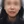 下巴異物取出（下巴假體移除） — 術前 (30天) · Returning醫美診所