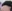 Forehead reduction (hairline lowering surgery) — The Fix Plastic Surgery Clinic
