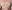 Breast reduction (reduction mammoplasty) — Uri Plastic Surgery Clinic
