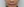 ศัลยกรรมยกริมฝีปากบน (Lip Lift) — หลังทำ (2วัน) · คลินิกความงามมิอินโด-สาขากังนัม