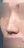 Nasal osteotomy (nasal bone narrowing) — before (7days) · Anersty Plastic Surgery Clinic