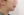 ตัดไขมันกระพุ้งแก้ม — ก่อนทำ (9วัน) · ไอรูมิ ศัลยกรรมพลาสติก