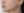 Thread lift — after · La Derma Clinic
