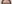 裏ハムラ法（経結膜的眼窩脂肪移動術） — ファクト美容外科クリニック