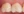 Composite resin filling — after (7days) · Yonsei Good Day Dental Clinic - Suseo Branch