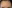 額縮小術（生え際下げ・ヘアライン下降術） — ヒート美容外科クリニック