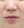 Chemical peel — before (21days) · J.Fill Clinic - Gangnam Branch