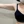 Brachioplasty (arm lift) — before (30days) · Cheongdam OK Plastic Surgery Clinic