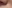 口角挙上 — ライク美容外科クリニック