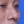 ผ่าตัดแก้ไขผนังกั้นช่องจมูกคด (Septoplasty) — หลังทำ (14วัน) · คลินิกโคบิจู