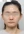 two-jaw surgery (bimaxillary orthognathic surgery) — before (90days) · A-Top Plastic Surgery Clinic