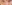 裏ハムラ法（経結膜的眼窩脂肪移動術） — プレジャー美容外科クリニック