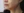 Thread lift — before · La Derma Clinic