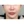 ผ่าตัดลดโหนกแก้มแบบเร็ว (ไม่ใส่ตัวยึด) — ก่อนทำ (90วัน) · ID Hospital - โรงพยาบาลหลัก