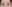 lower blepharoplasty (under-eye bag removal with fat repositioning) — Dasipium Plastic Surgery Clinic