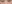 裏ハムラ法（経結膜的眼窩脂肪移動術） — ST美容外科(エスティ美容外科)