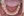 จัดฟันเฉพาะส่วนด้านใน 2D (2D lingual partial braces) — หลังทำ (126วัน) · คลินิกทันตกรรม Lucent