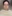 クイック頬骨縮小術（固定なし・短期回復型） — BN Plastic Surgery Clinic