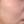CryoCell (cryo-electrophoresis cooling + active-ingredient infusion; post-laser soothing care) — before (14days) · U&Me Clinic