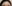 額縮小術（生え際下げ・ヘアライン下降術） — ララ美容外科クリニック