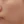 Rejuran S (รีจูรัน S กล่องน้ำเงิน — หลุมสิว/แผลเป็น) — ก่อนทำ · พิกเซลแล็บศัลยกรรมพลาสติก