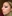 Lower Eyelid Fat Repositioning (transconjunctival) — Uri Plastic Surgery Clinic