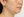 Oligio / Oligio X (โอลิจิโอ) — ก่อนทำ (30วัน) · คลินิก Le Shine