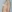 Breast augmentation with implants — Arc Plastic Surgery Clinic
