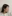 頬骨縮小術（頬骨弓・外側） — オペラ美容外科クリニック