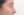 Paranasal (nasal base) augmentation with implant — after (14days) · iLumi Plastic Surgery Clinic