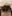 Scalp hair transplant — Mo&Line Plastic Surgery