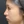 Nose tip filler — after · Erne Clinic