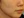 เลเซอร์ Fraxel (Fractional Laser) — หลังทำ (7วัน) · คลินิก Le Shine