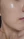 PRP skin rejuvenation (platelet-rich plasma therapy) — after (7days) · U&Me Clinic - Hongdae Branch