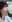 Lip lift (philtrum reduction) — Ondo Plastic Surgery