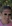 Lower Eyelid Fat Repositioning (transconjunctival) — Uri Plastic Surgery Clinic