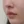 โบท็อกซ์ร่นร่องริมฝีปาก (Lip Flip ทำให้ร่องใต้จมูกดูสั้นลง) — หลังทำ (7วัน) · คลินิก Younme