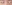 裏ハムラ法（経結膜的眼窩脂肪移動術） — プレジャー美容外科クリニック