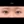 ผ่าตัดแก้ขนตาทิ่มตา (ขนตาแยงตา / เปลือกตาม้วนเข้า) — หลังทำ (31วัน) · รพ.ศัลยกรรมตกแต่งโอลโล