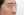 Paranasal (nasal base) augmentation with implant — before (14days) · iLumi Plastic Surgery Clinic