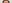 糸リフト（スレッドリフト） — A-Top美容外科クリニック