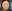 Double chin liposuction (submental liposuction) — Saegim Plastic Surgery Clinic