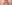 人中短縮（リップリフト） — ライク美容外科クリニック